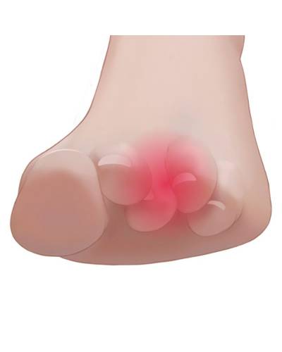barrettes de soutien d'orteils en griffe pharmaconfort