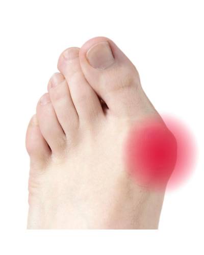 hallux valgus, oignon protection et écarteur orteil pharmaconfort