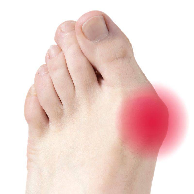 hallux valgus, oignon protection et écarteur orteil pharmaconfort